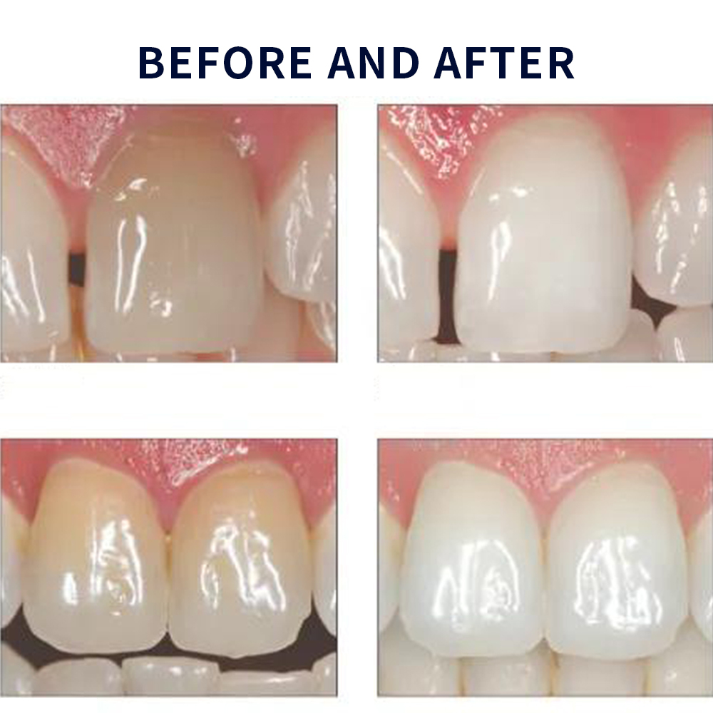 Opalescence Whitening 20% PF 2 - Teeth Whitening Gel Peroxide 评论和价格
