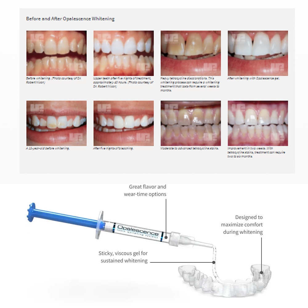 Opalescence Whitening 20% PF 2 - Teeth Whitening Gel Peroxide 评论和价格
