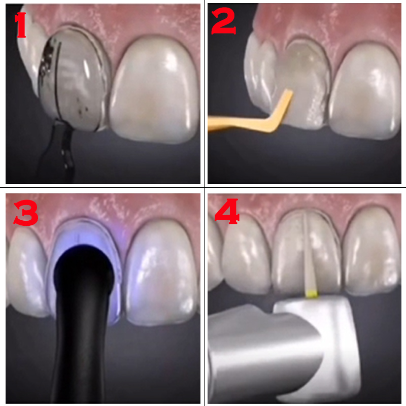 Dental Mold for Composite Resi - Teeth Whitening Veneers 评论和价格