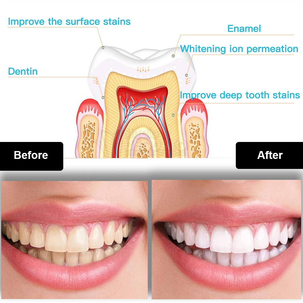 Dental Teeth Whitening Kit Min - Whitening Pen Bleach 评论和价格